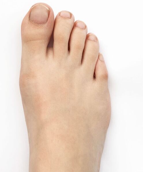 Ech geheelt mäin Daum valgus mat Hondro Sol Valgus Spray
