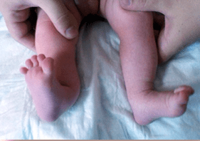 Valgus Verformung a Kanner Symptomer