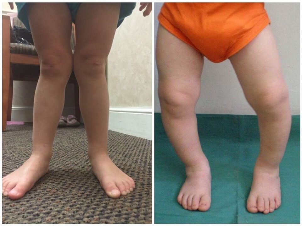 Valgus Verformung an de Kanner verursaacht