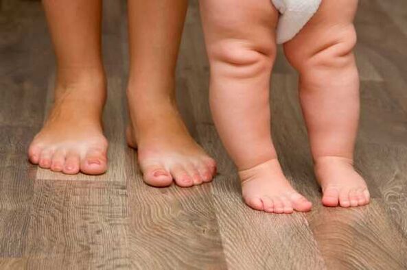 Valgus Verformung bei Kanner