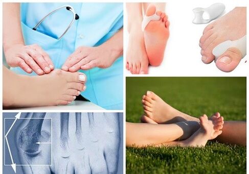 Behandlung vu Valgus Deformatioun