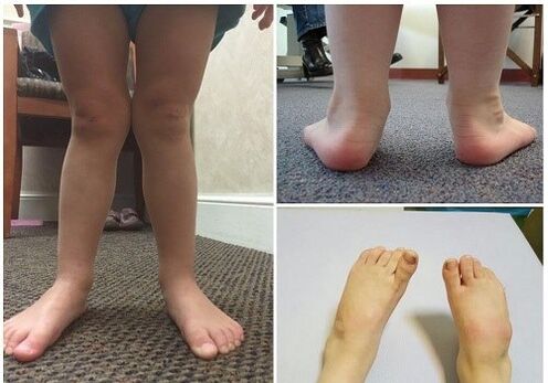 Valgus Verformung bei Kanner