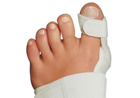 Valgus Verformung