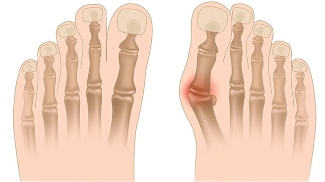 Behandlung vu Valgus Deformatioun