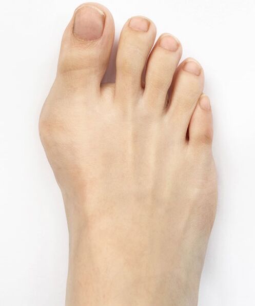 hallux valgus ier Dir Hondro Sol Valgus Spray benotzt